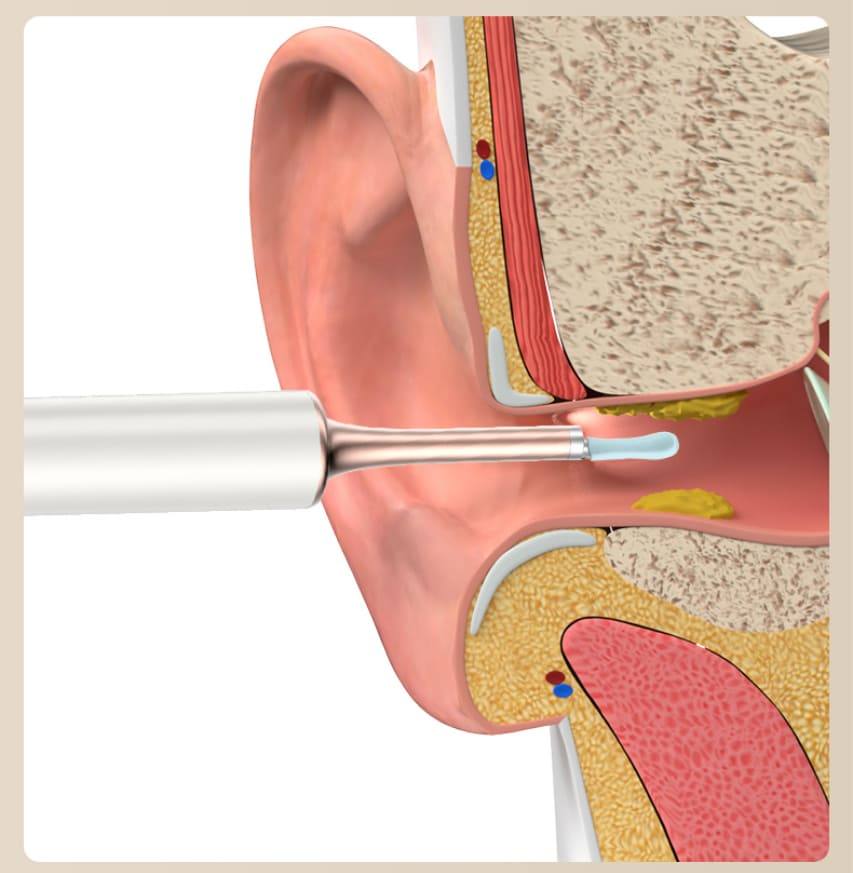earwax remover cleaning the ear